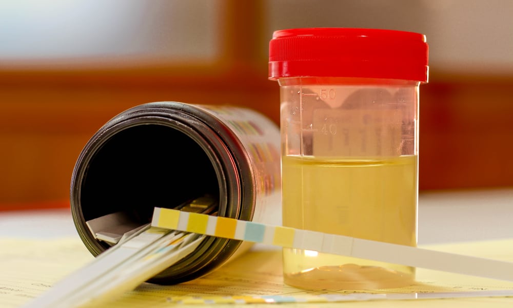Drug test urine sample