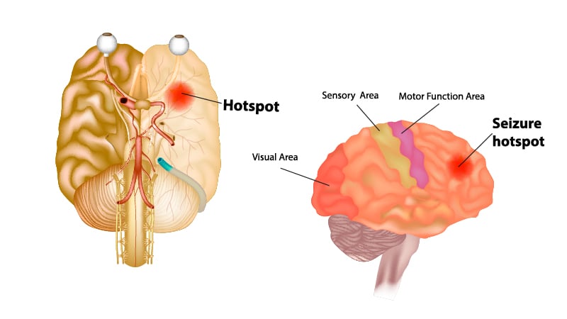 Illustration of human brain having epilepsy on white background