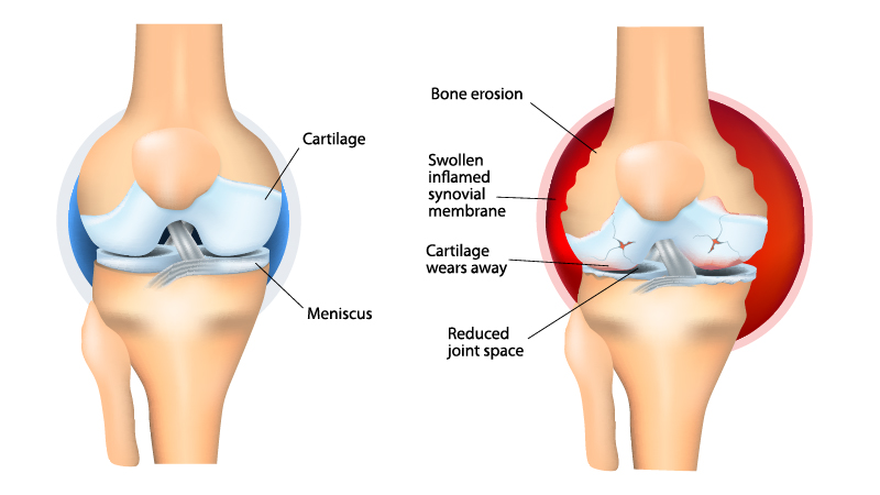Illustration of Rheumatoid Arthritis Vs Health Joint