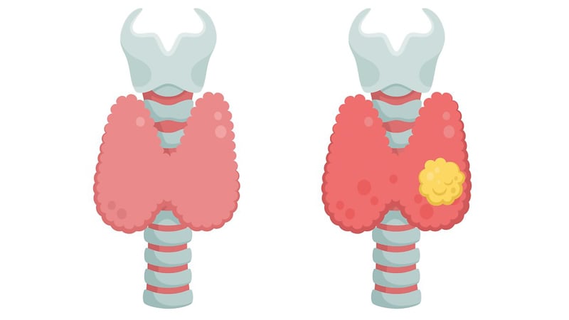 Illustration of healthy vs. unhealthy thyroid in white background