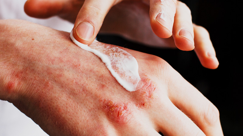 A man applying CBD cream on his hand with shingles nerve pain