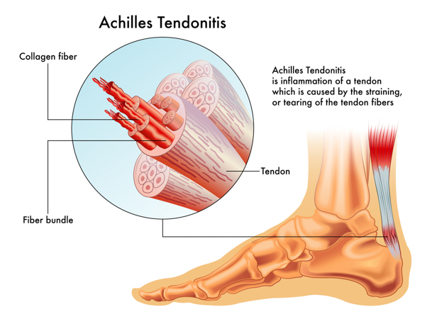 Archilles Tendonitis Illustration