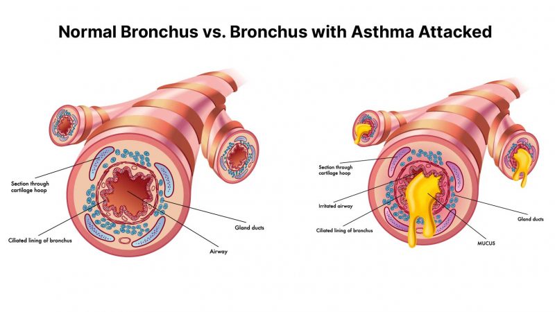 illustration of bronchospasm asthma on a white bacground