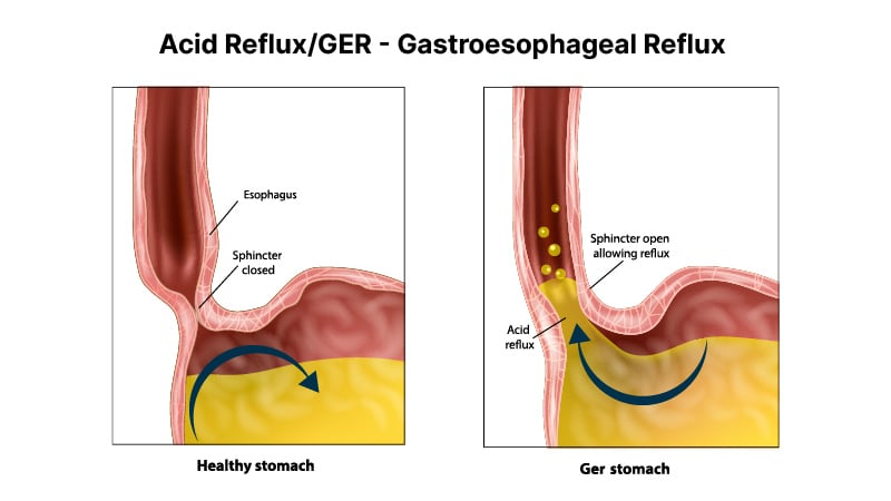 acid reflux ger illustration on a white background