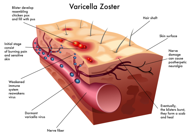 shingles varicella zoster virus illustration