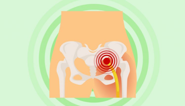 Sciatica Nerve Pain Illustration