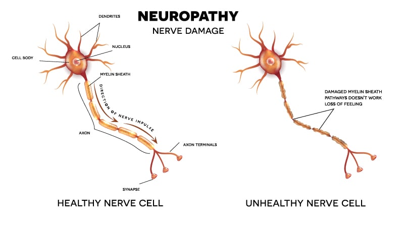 Healthy vs Unhealthy Neuropathy Nerve cells