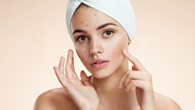 a women with acne condition on her skin