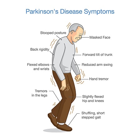 Parkinson's Disease Symptoms Illustration