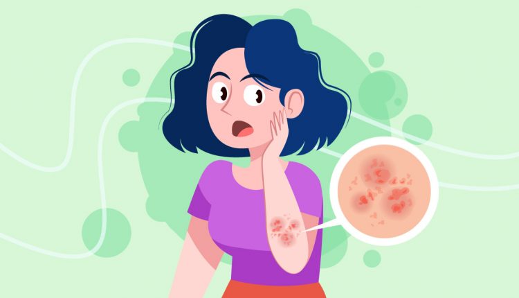illustration of a woman with eczema on her arm