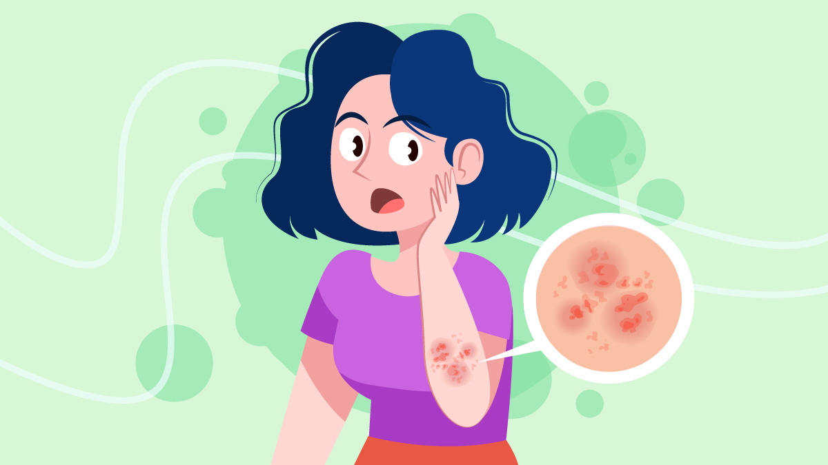 illustration of a woman with eczema on her arm