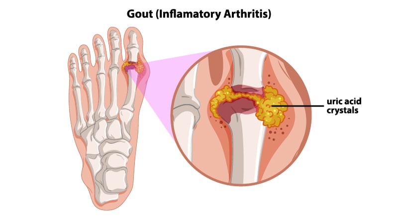 Gout Illustration