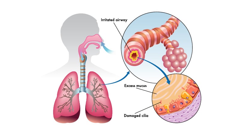 COPD Illustration on white background