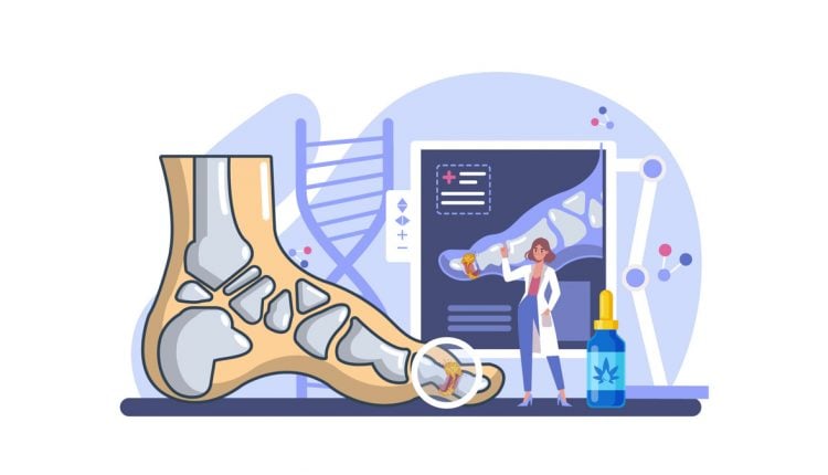 Illustration of how CBD Oil Works for Gout