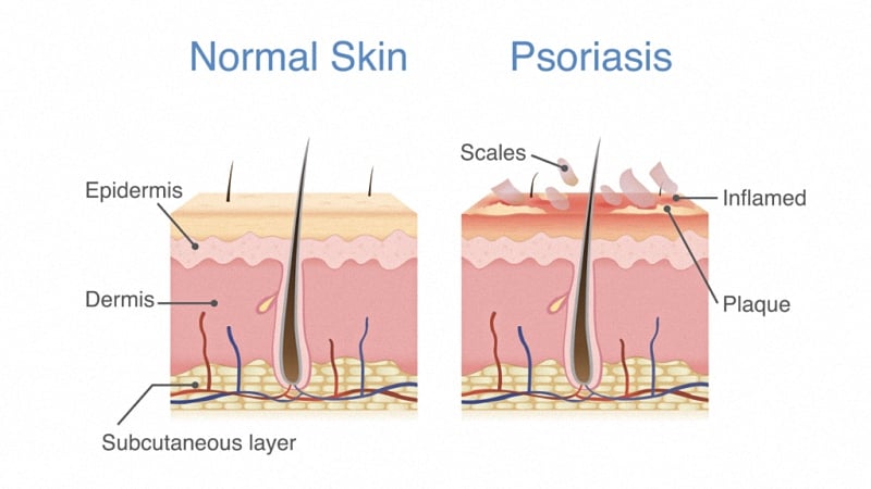 Psoriasis Illustration