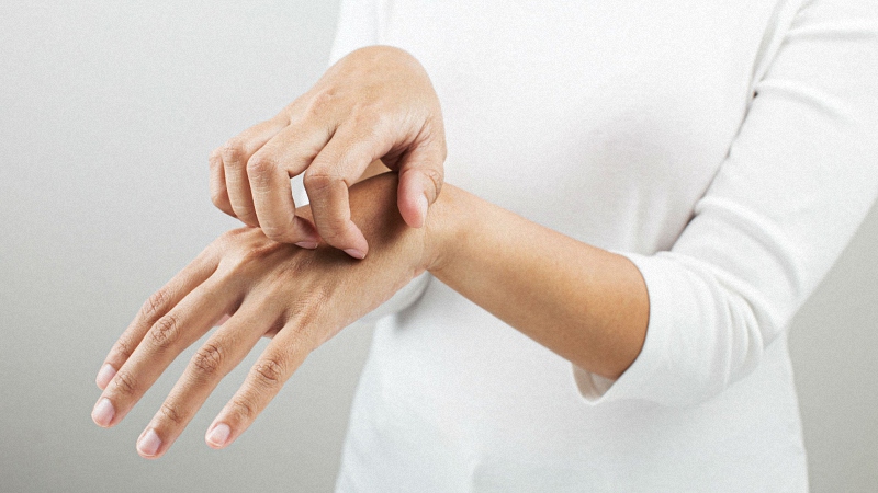 Woman Scratching Her Hands Due to Allergy