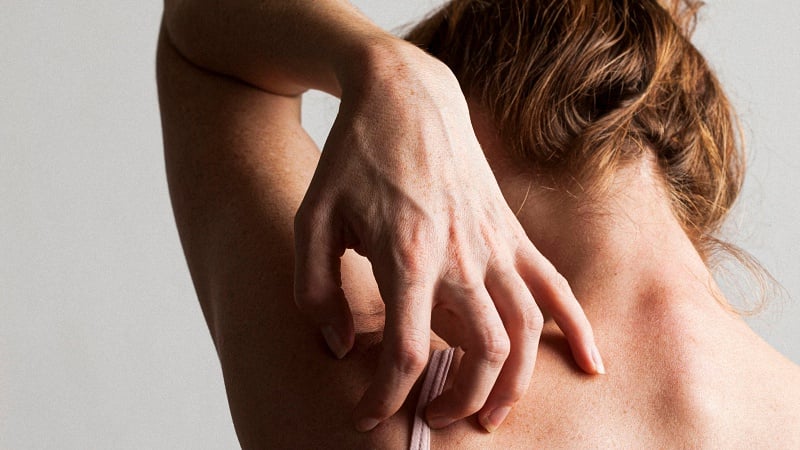 Woman Scratching her back due to allergy